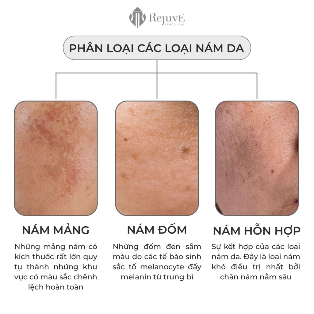 phân loại các loại nám da 