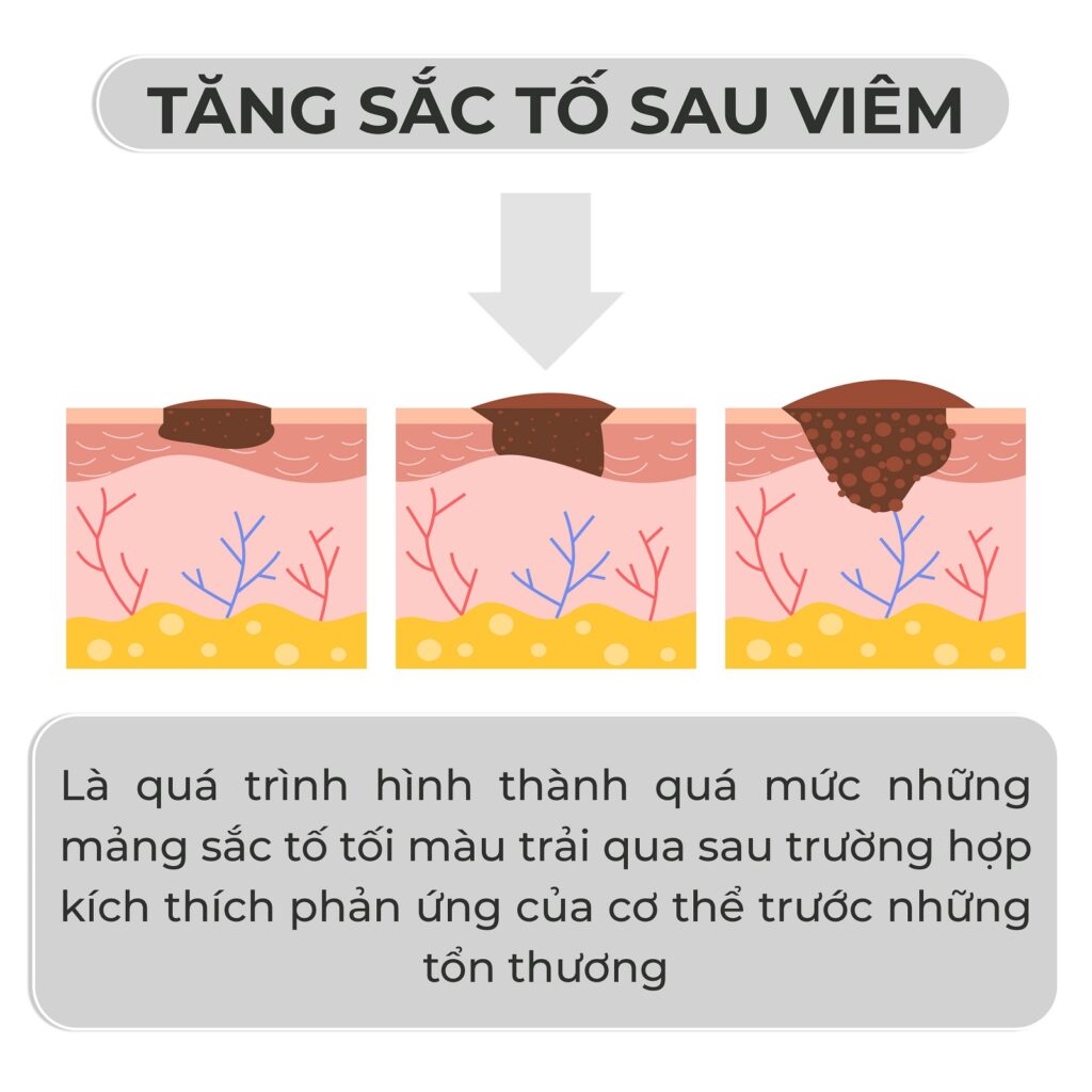 tăng sắc tố sau viêm là gì rejuve